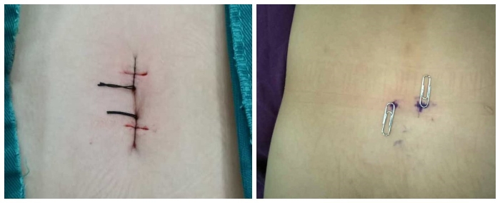 微創(chuàng)手術切口 微創(chuàng)手術切口